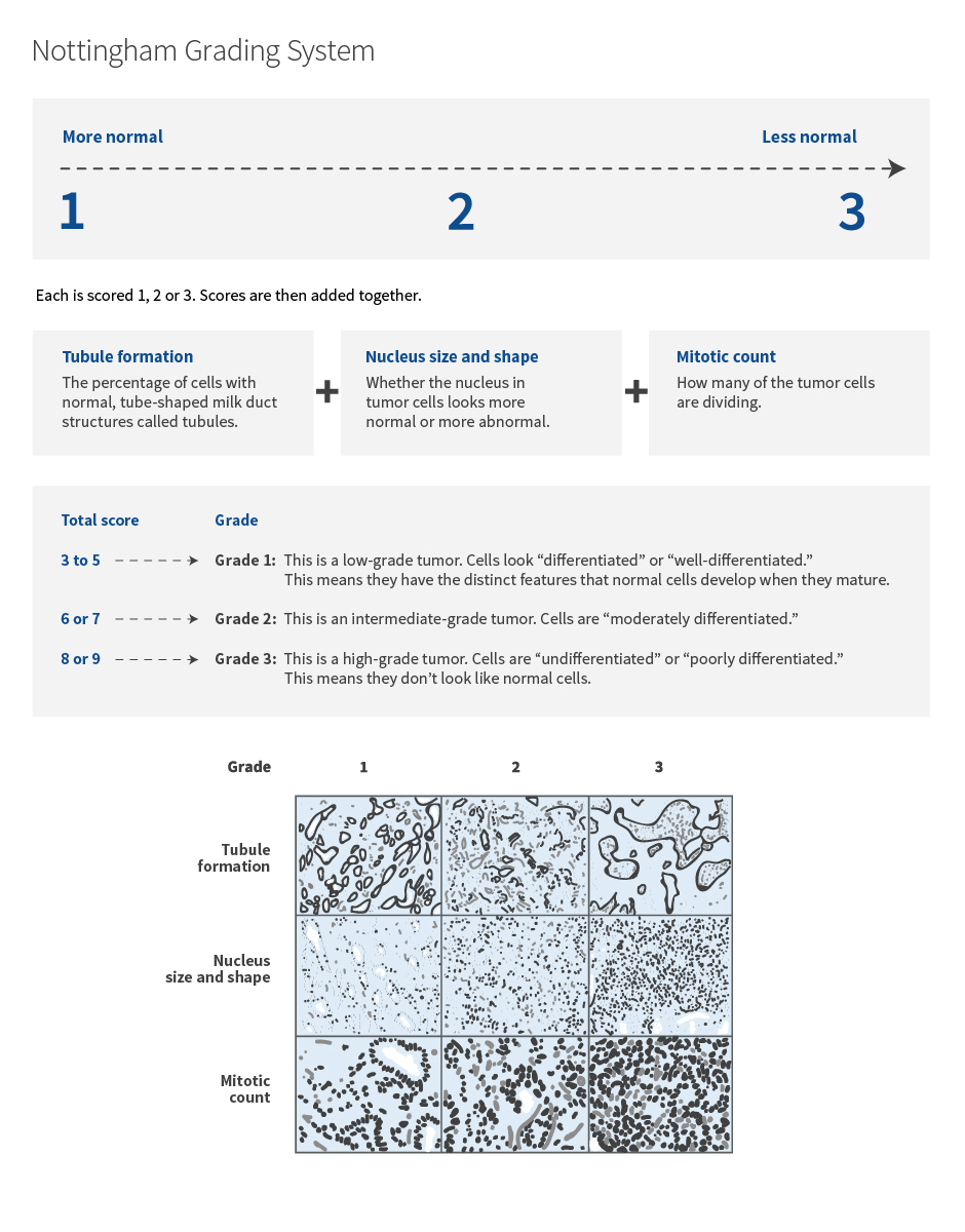 Chart explaining the Nottingham grading system for breast cancer tumors