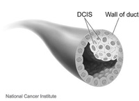 Ductal carcinoma in situ (DCIS) is a noninvasive type of breast cancer. This diagram from the National Cancer Institute illustrates DCIS and the wall of the duct.