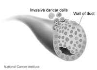 Invasive ductal carcinoma (IDC), also called infiltrating ductal carcinoma, is the most common breast cancer diagnosis.