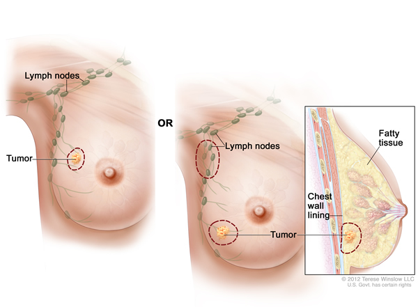 Medical illustration of breast with small tumor and lymph nodes to be removed by lumpectomy