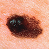 An asymmetrical melanoma