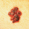 A melanoma with irregular edges