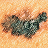 A melanoma with color variations