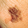 An example of a melanoma, which is typically more than 6mm in diameter.