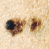 An example of a mole that has changed in some way over time.