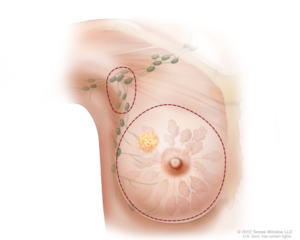 Medical illustration of total simple mastectomy in which entire breast and adjoining lymph nodes are surgically removed