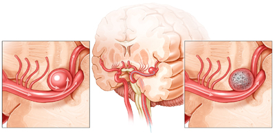 Aneurysm Coil