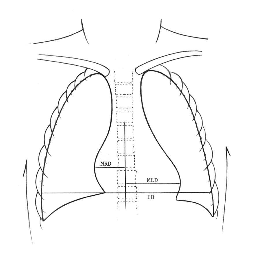 DRAD Pediatric Normal Measurements Cardiothoracic lung diagram