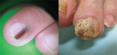 Examples of diseases of the nails.