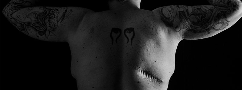 A portrait of a melanoma survivor and her scar.