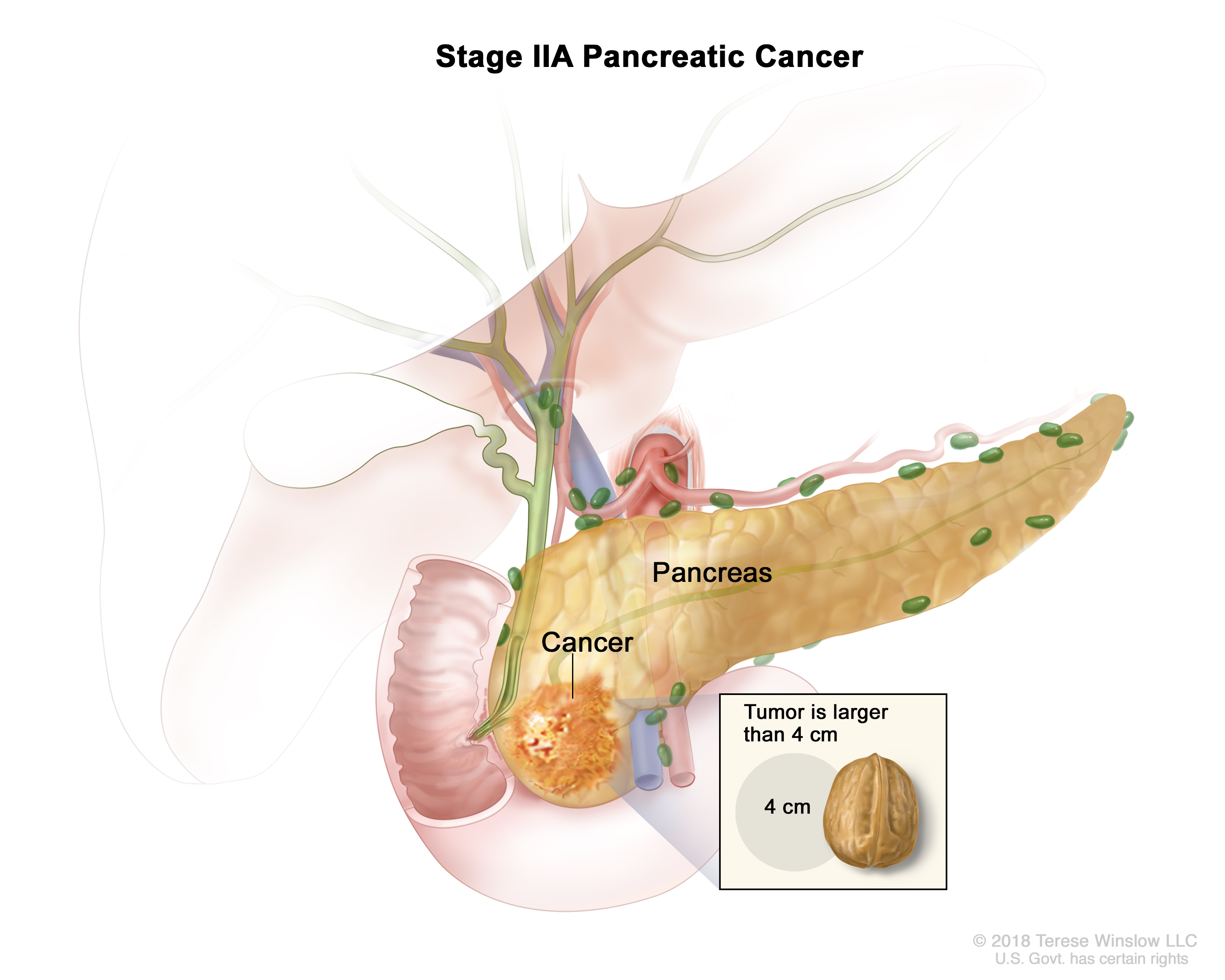 Diagram illustrating stage IIA Pancreatic Cancer, with an inset showing the size comparison of the tumor and a 4cm walnut