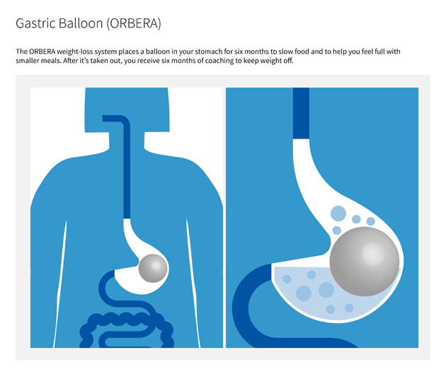 Illustration of Gastric Balloon