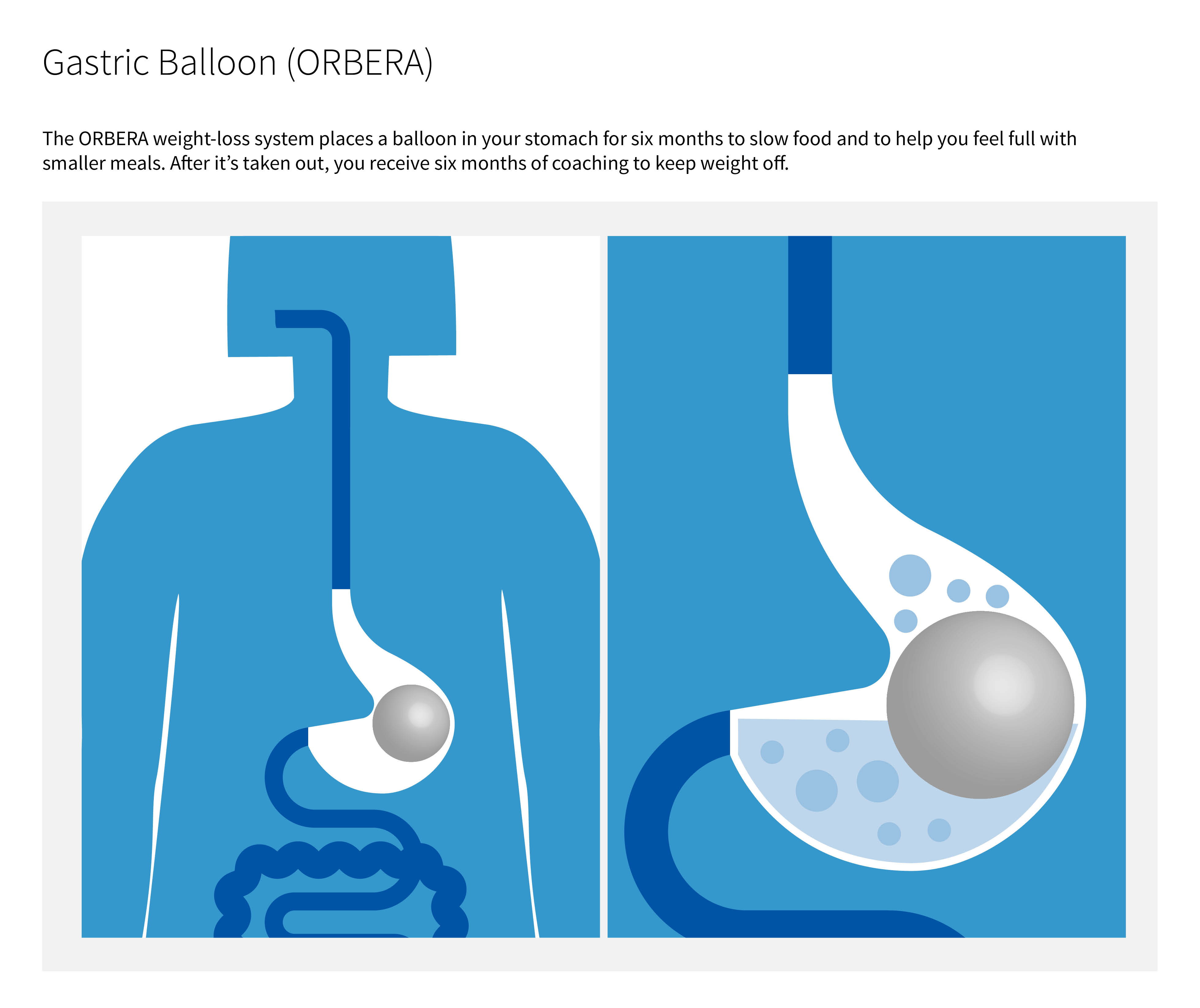 Illustration of gastric balloon full size