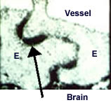 After blood-brain-barrier disruption, the blood-brain barrier is permeable, as shown by this electron micrograph of the stained peroxidase enzymes between endothelial cells