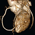 3-D rendering of a heart using 256-slice CT scanner