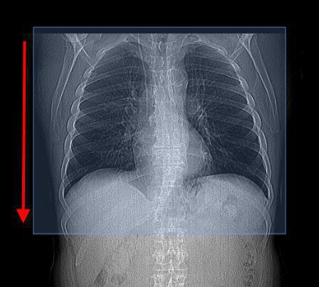 mesothelioma average life expectancy