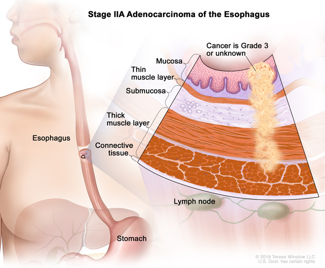 Stage IIA Adenocarcinoma of the Esophagus (esophageal cancer), with inset showing detail of the layers of the esophagus