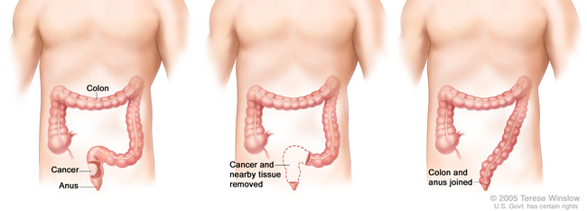 Medical illustration of resection of the rectum with anastomosis (portion of rectum is removed and the remainder is reattached to the colon)