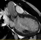 Cardiac MRI for Radiology