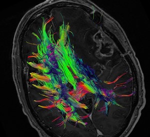 Diagnostic Radiology Neuroradiology DTI Image B