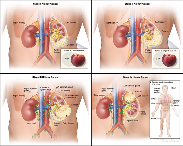 Medical illustration of kidney cancer stages I, II, III, and IV