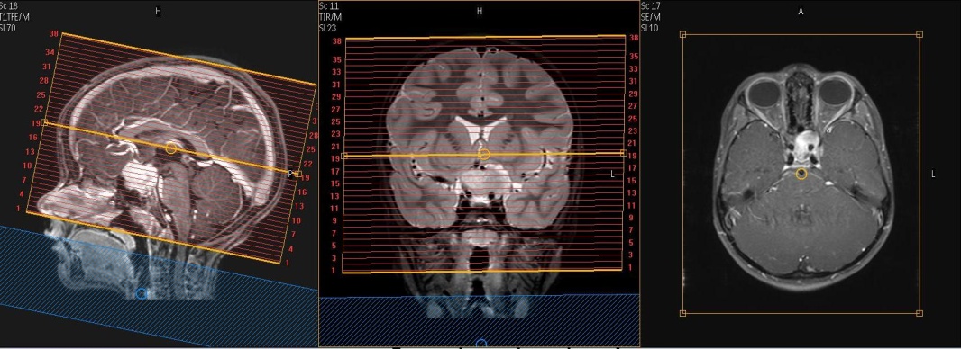 MR Brain Orbits PACS Image