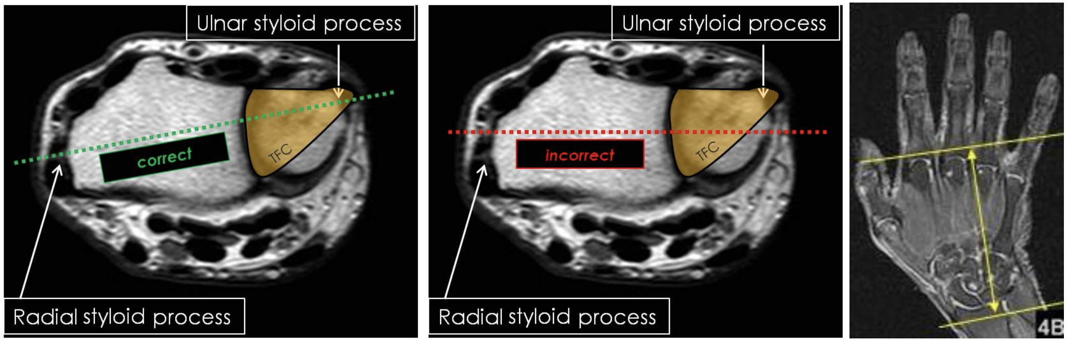 MR Wrist Rheumatology Image