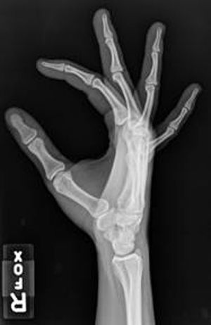 X-Ray of a hand for radiology