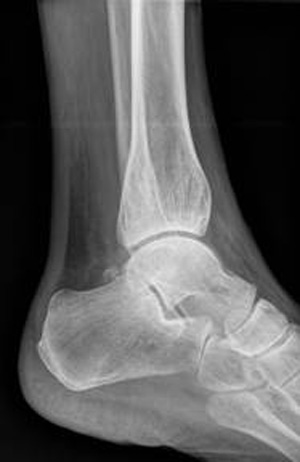 MSK Heel Image for radiology