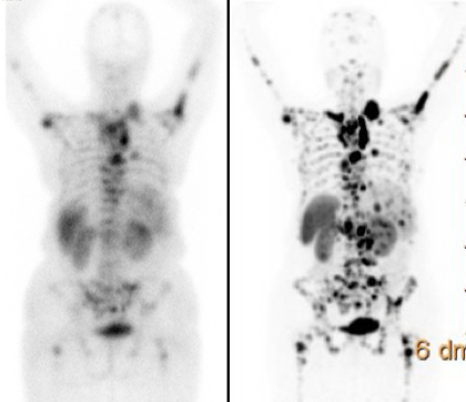 Nuclear Medicine Radionuclide Therapy for Radiology