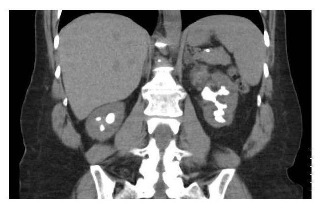 Kidney stone see on radiology scan