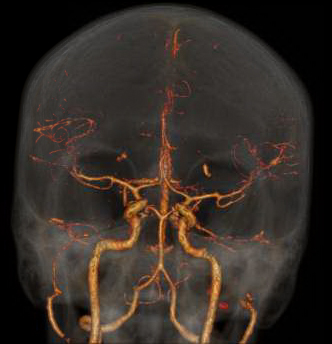 CTA of the Head and Neck image C for Radiology 