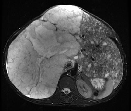 Body MRI Liver for Radiology