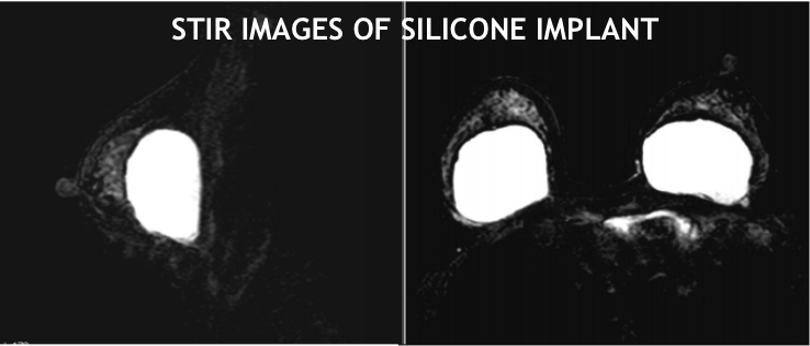 MR Breast STIR Silicone Implant