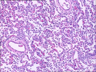 Acute lung injury from endotoxin inhalation