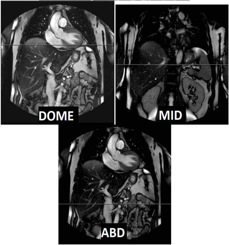 MR Adult Liver Mass WWO + Fe Quantification BODY Protocol image