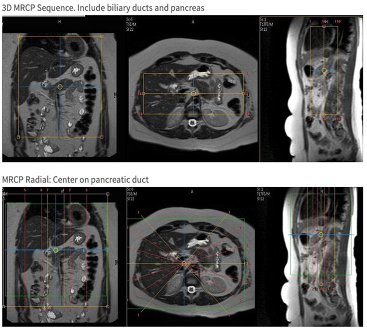 MR Adult Pancreas WWO with MRCP BODY Protocol image