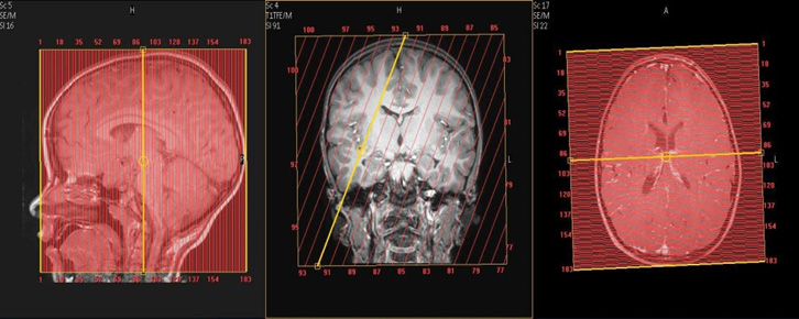MR Brain & Orbits WWO (Peds) ENT Protocol image1