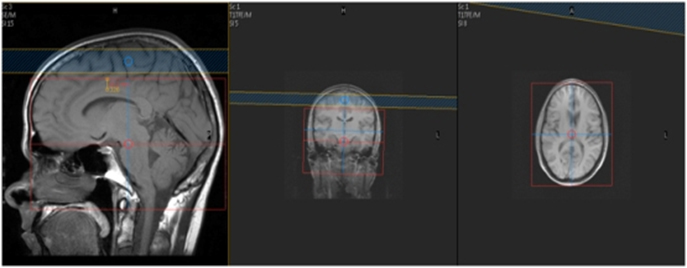 MR Brain Vasculitis WWO + MRA Neuro Protocol