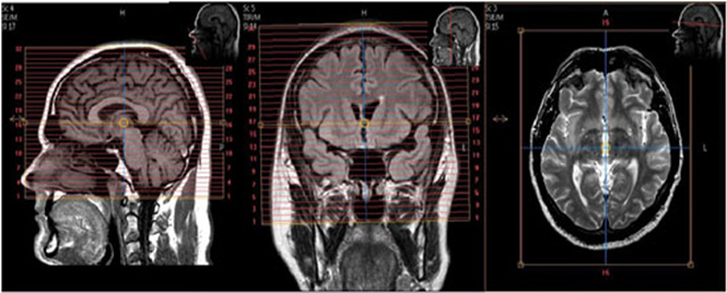 MR Brain WO Neuro Protocol - Ingenia scanner Image