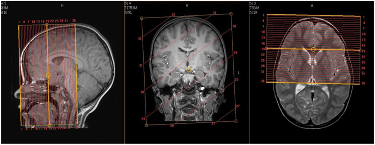 MR Brain and Orbits WWO image 2