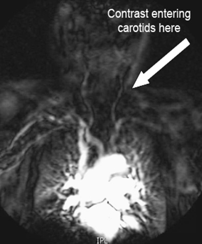 MRI Carotid Dissection WWO Neuro Radiology Protocol