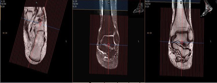MR Foot - Hindfoot WO or WWO MSK Protocol image 1
