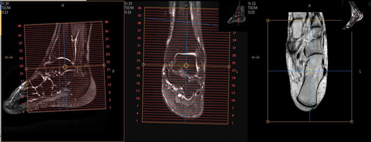 MR Foot - Hindfoot WO or WWO MSK Protocol image 2