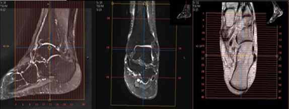 MR Foot - Hindfoot WO or WWO MSK Protocol image 3