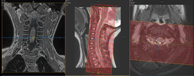 MR Peds Cervical Spine Image 3
