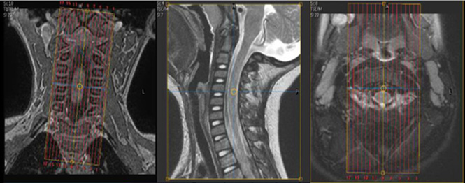 MR Peds Cervical Spine Image 1