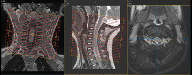 MR Peds Cervical Spine Image 2