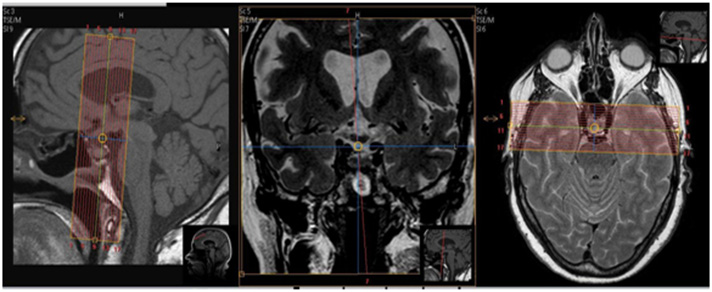 MR Pituitary WWO + Radiation Therapy Planning Neuro Protocol Image1
