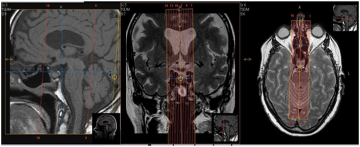 MR Pituitary WWO + Radiation Therapy Planning Neuro Protocol Image2